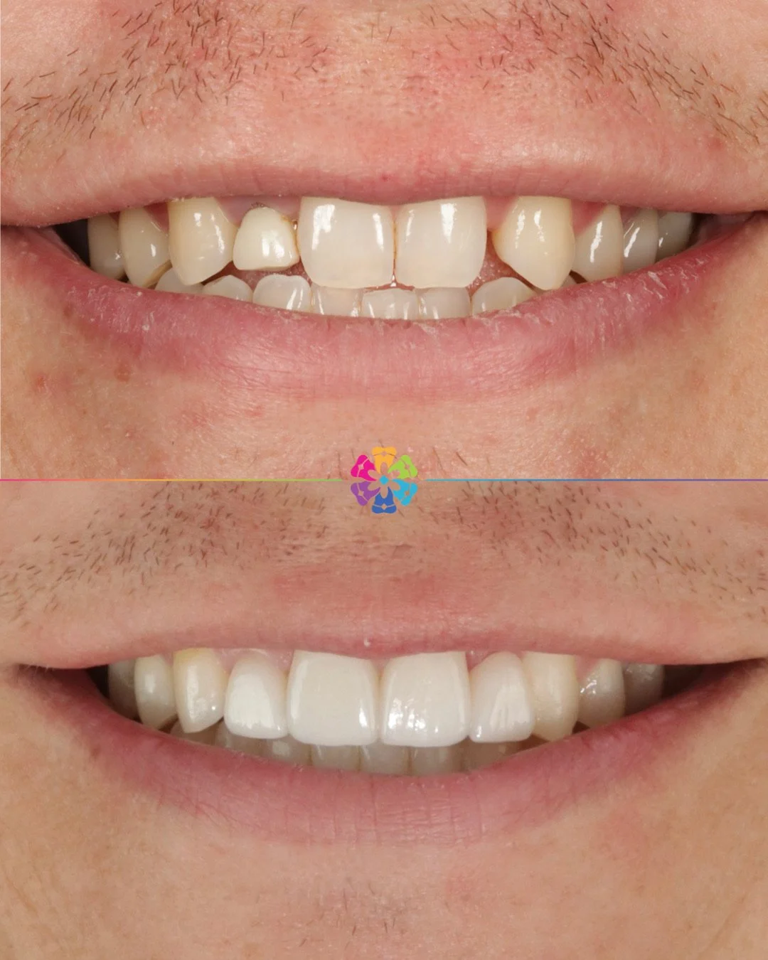‼️ Complex Case ‼️

Before 📸
- Missing UL2, small crown UR2 &amp; upper central teeth in cross bite

After 📸 How was this achieved?

1. Invisalign to position the teeth
��- create overjet as upper central teeth clashing
��- open space around latera