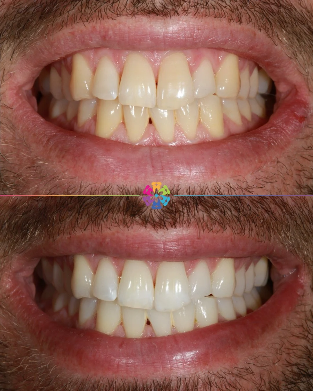 Boutique Whitening Results 💫

Our home whitening kits include Bespoke whitening trays and 4 tubes of bleaching gel! 

#dentist #dentalsmiles #dentalsmilesessex #dentalsmileschelmsford #dentalsmilesessex #dentalsmilestakeley #essex #compositefillings
