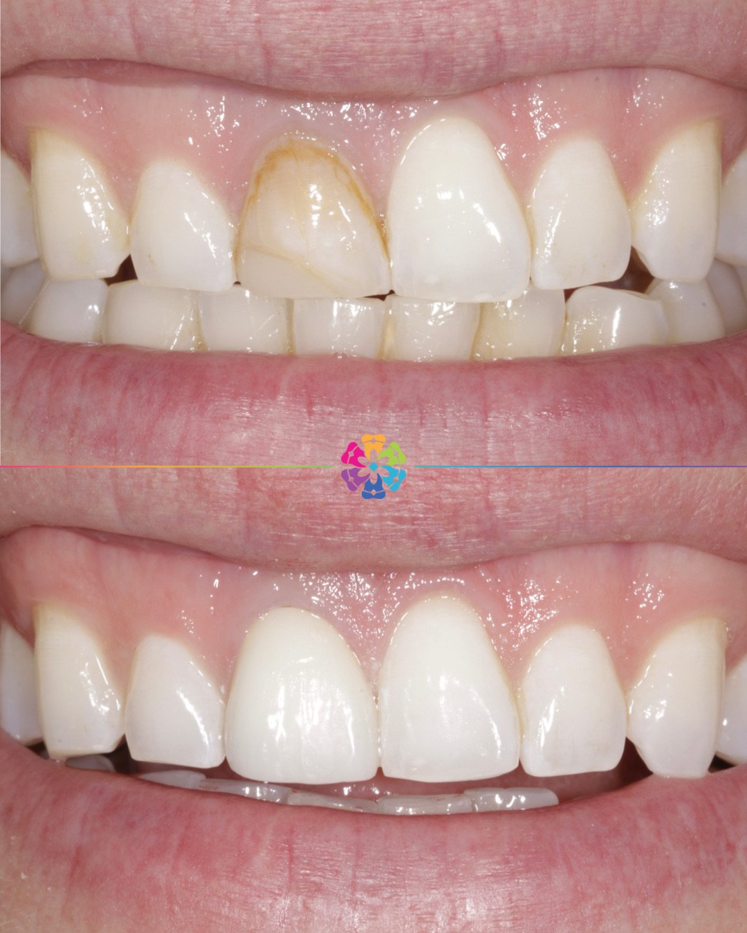Front Tooth Veneer 🦷

After having root canal treatment, the tooth can darken as a result. This patient experienced this and wanted to improve the appearance.

Dr Sharpe resolved this by doing a veneer to mask the discolouration 💫

#dentist #dental