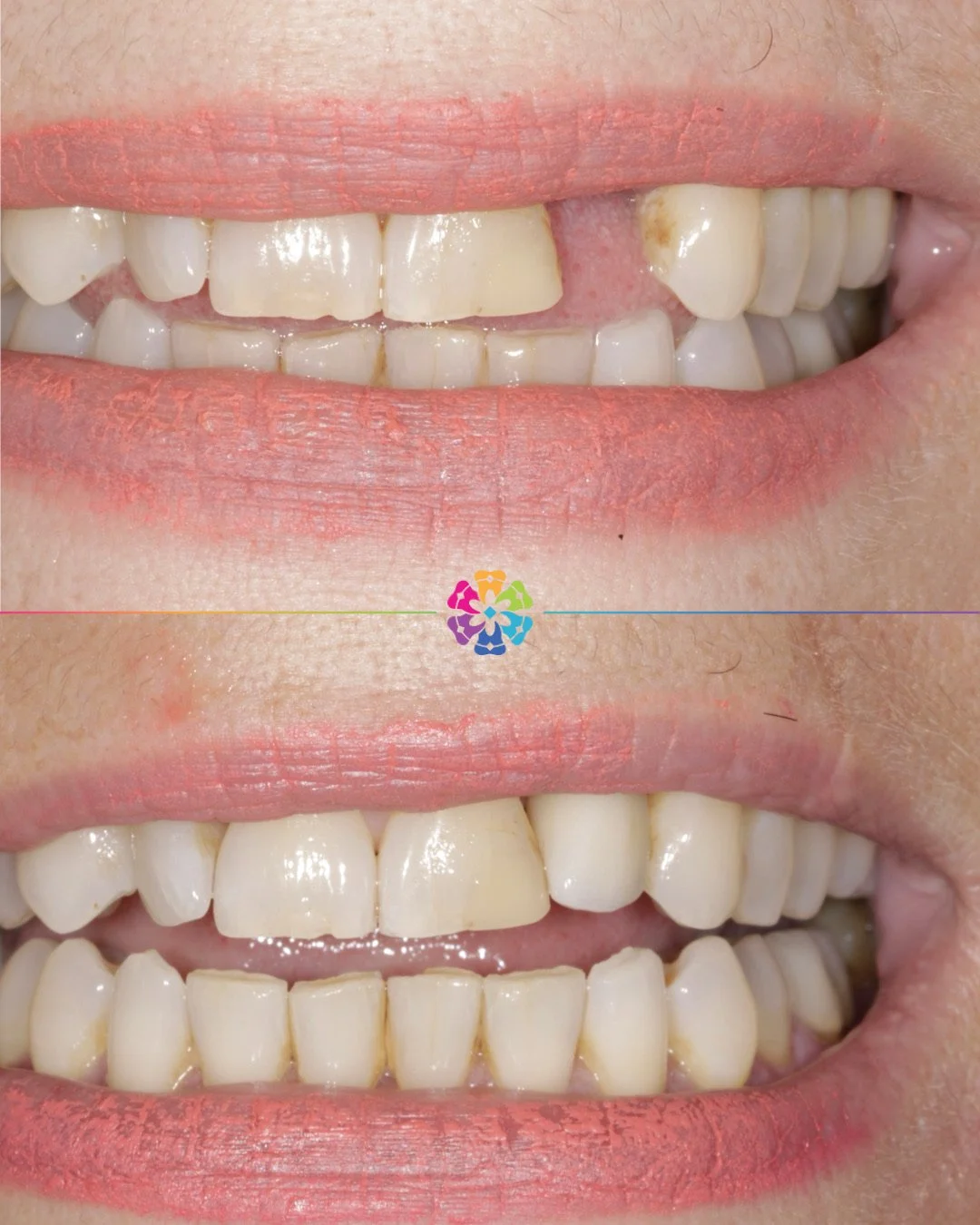 Implant Case 🔩

Dental Implants are the better long term treatment option 

✅ Improved Appearance &amp; Function: implants look and work like natural teeth

✅ Preserves Bone: it prevents jawbone loss that occurs when teeth are missing

✅ Supports Ad