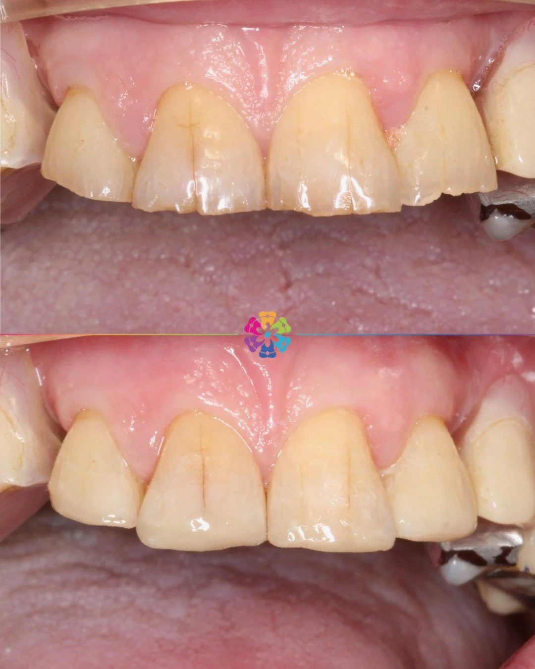 Composite Bonding to repair worn edges 🦷

✔️ Prevents further wear
✔️ Improves appearance 
✔️ Reduces sensitivity 

#dentist #dentalsmiles #dentalsmilesessex #dentalsmileschelmsford #dentalsmilesessex #dentalsmilestakeley #essex #compositefillings #
