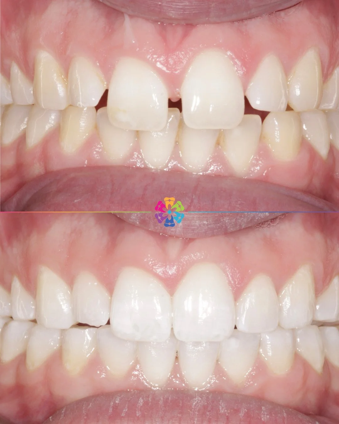 Invisalign &amp; Whitening 🦷

✔️ Spaces closed
✔️ Brighter smile

Fantastic result by Dr Manish! 

#dentist #dentalsmiles #dentalsmilesessex #dentalsmileschelmsford #dentalsmilesessex #dentalsmilestakeley #essex #compositefillings #veneers #invisali