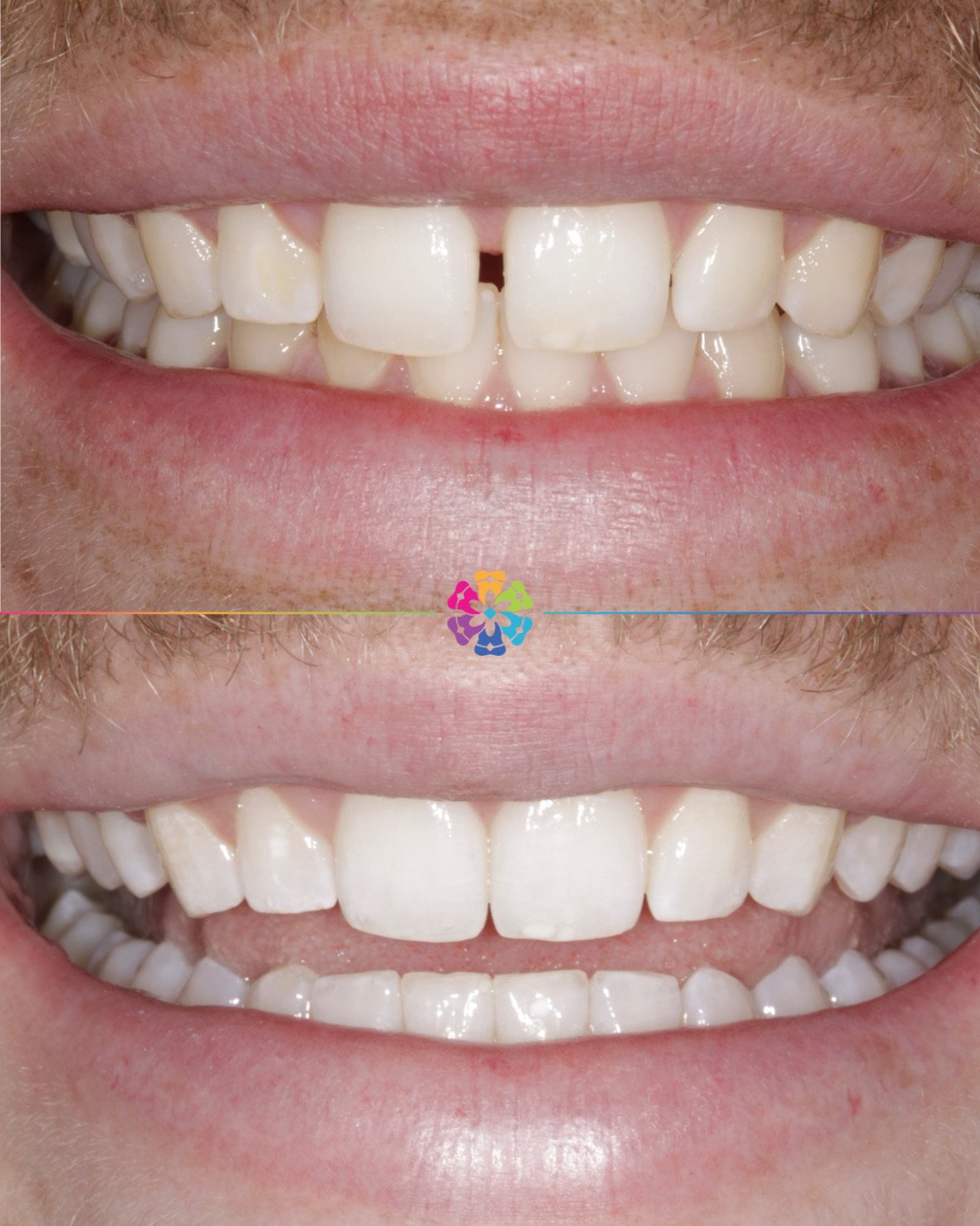 Invisalign Case ✨

Main concern: Midline Gap

Corrected in just 6 months ⏱️

#dentist #dentalsmiles #dentalsmilesessex #dentalsmileschelmsford #dentalsmilesessex #dentalsmilestakeley #essex #compositefillings #veneers #invisalign #invisaligndentist #