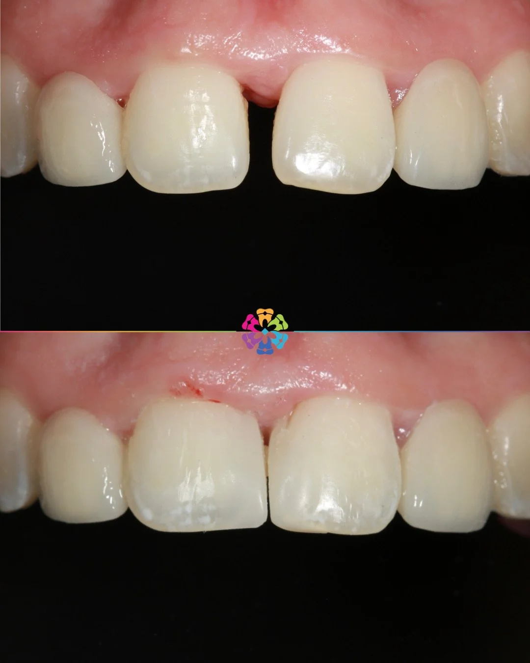 Composite Bonding 🦷

Natural spacing between the front teeth can be closed using composite bonding. This is a simple, effective way to change the appearance of the teeth ✨

Same day results by Dr Manish!

Book in your composite bonding consultation 