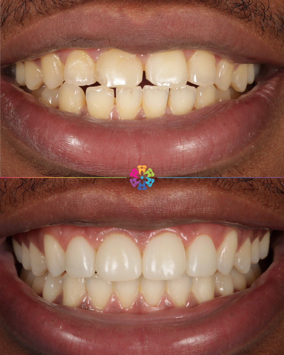Complex Case 🚨

This patient was recommended to Dental Smiles after their family member had finished their treatment 

Patient Concerns: 
Disliked his teeth - wanted whiter teeth and for them to look more even.

Dentist Findings:
The teeth were chip