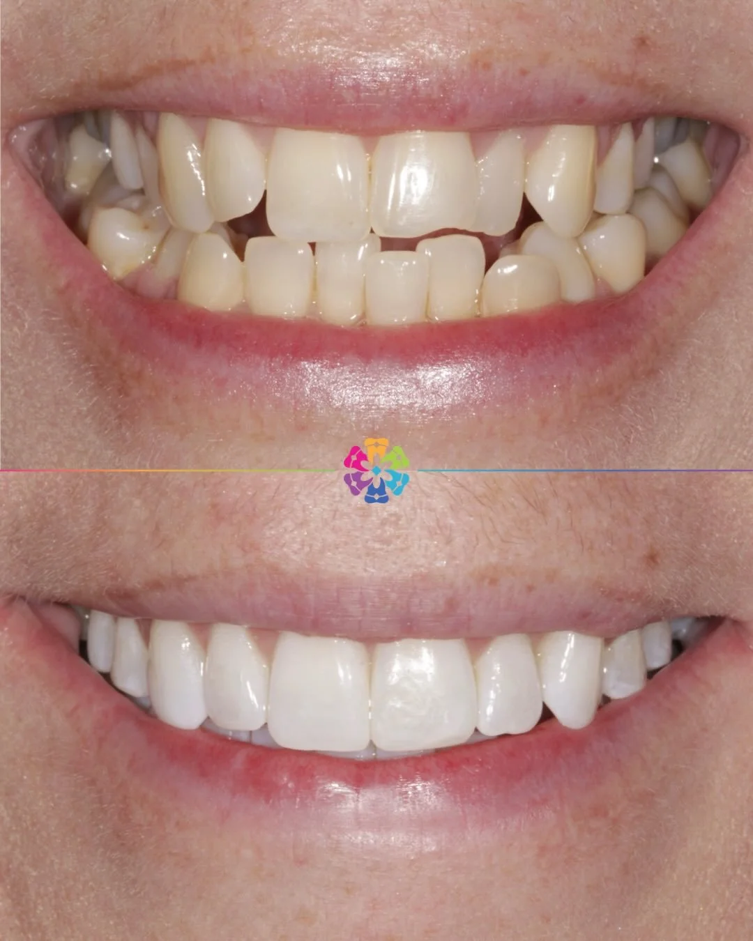 Invisalign planned with CBCT scan 💫

A CBCT scan shows tooth anatomy and bone structure which helps predict tooth movement. 

Smile transformed in 12 months ✅

Fantastic results by Dr Andy Sharpe 👨🏽&zwj;⚕️

#dentalsmilesessex  #essex  #invisalignj
