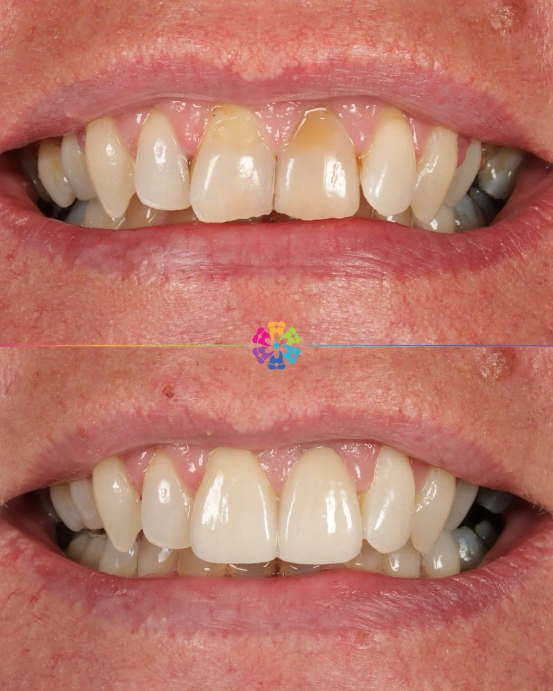 Veneers ✨

Smile transformed by Dr Katy Sharpe to restore previous wear on the teeth and give this patient a new bright smile

#dentist #dentalsmilesessex #veneers #naturalsmile #essex