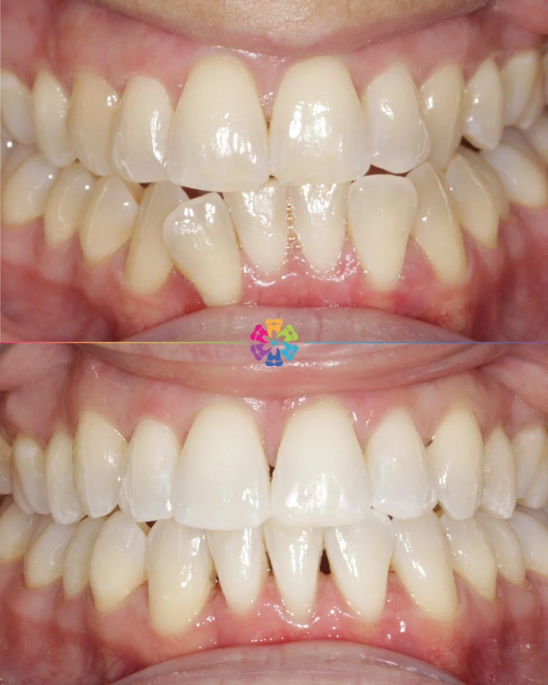 Invisalign with lower extraction ✨

This case took just 10 months ⏳

Book your consult today 📲

#dentist #dentalsmiles #invisalign #invisalignsmile #essexdentist