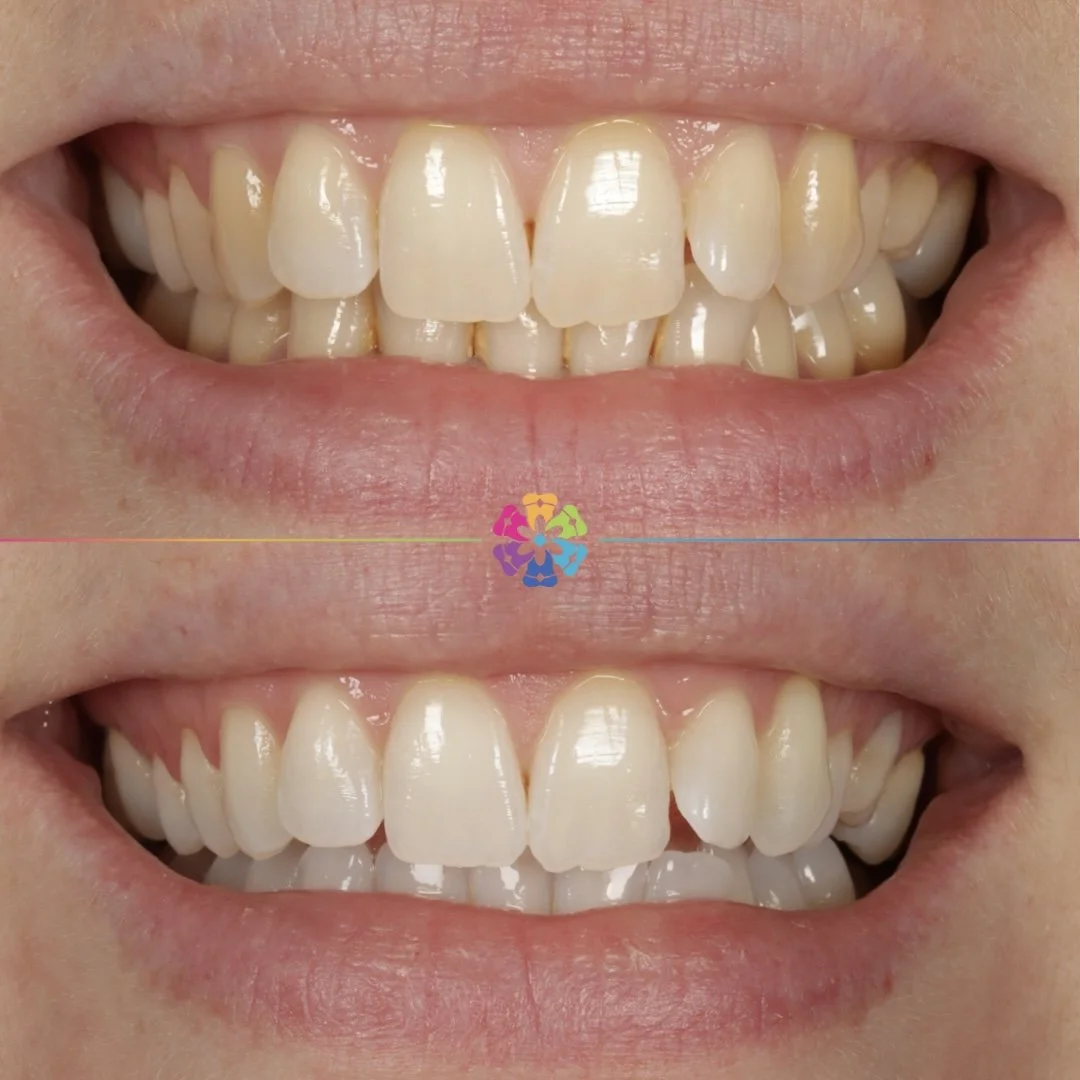 Teeth-whitening-before-and-after Dental Smiles