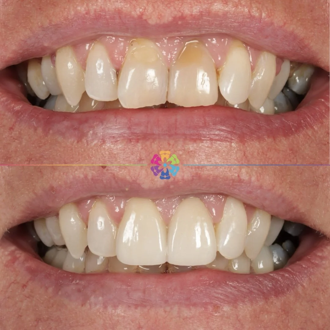 Veneers