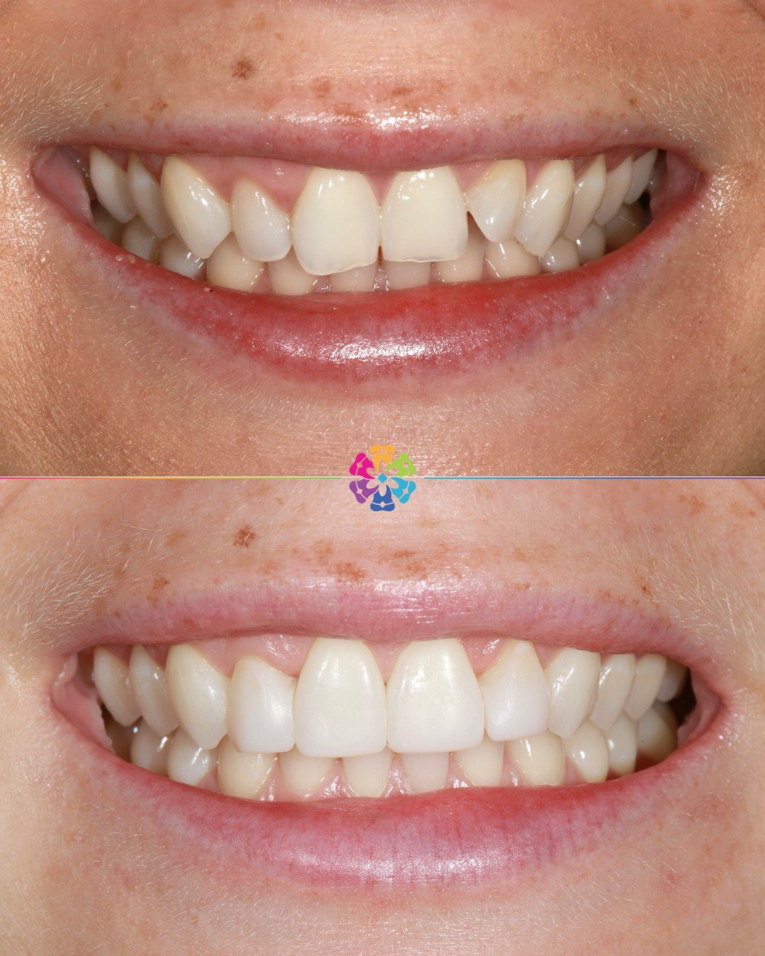 Another amazing before &amp; after case, to complete this stunning smile we used Invisalign, Whitening &amp; Composite bonding.

👨🏼&zwj;⚕️Completed by Manish Jagatiya
📍Dental Smiles Chelmsford

📧Dm for more info!

#dentalsmilesessex #invisalign #