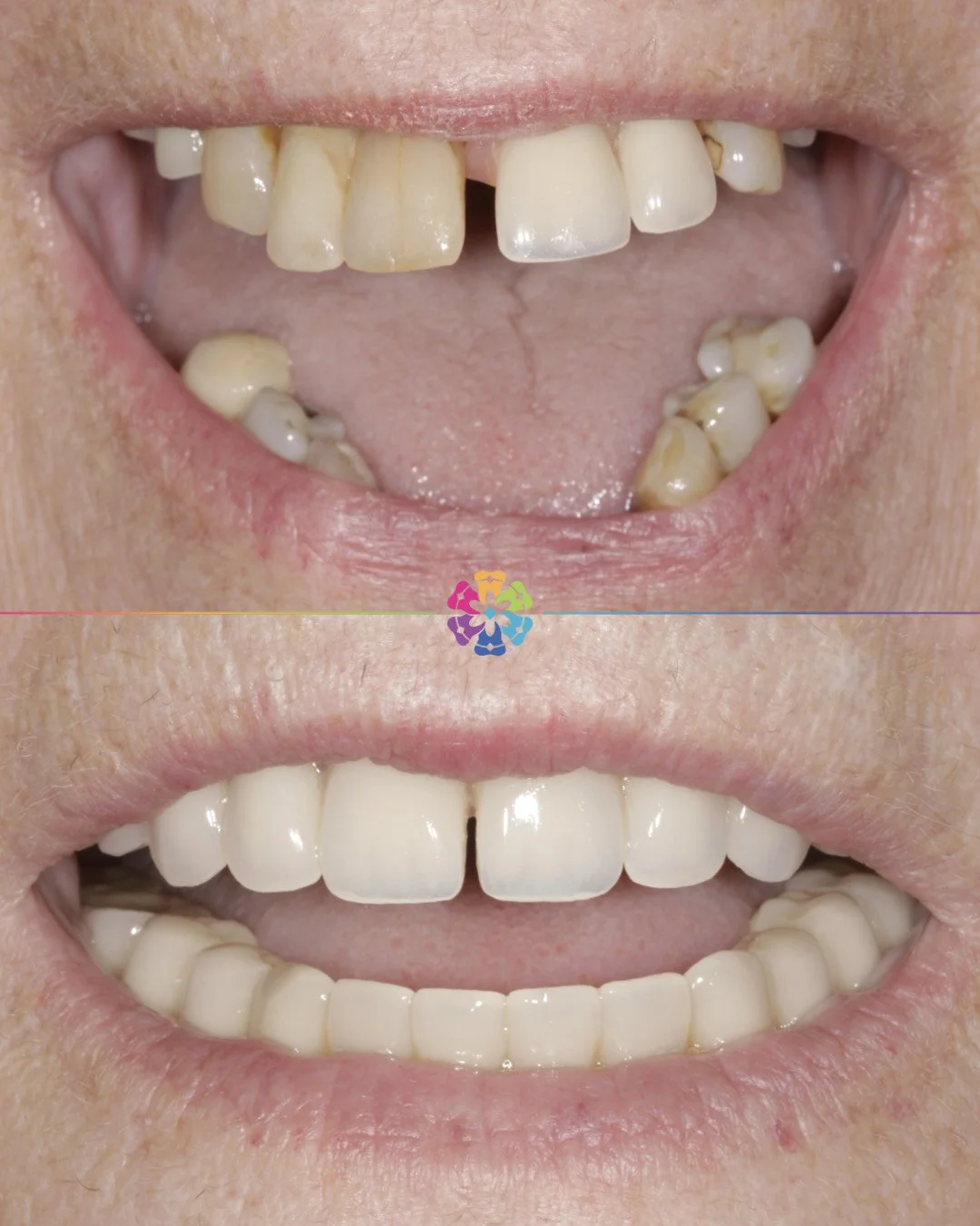Implant-retained dentures – Case Study