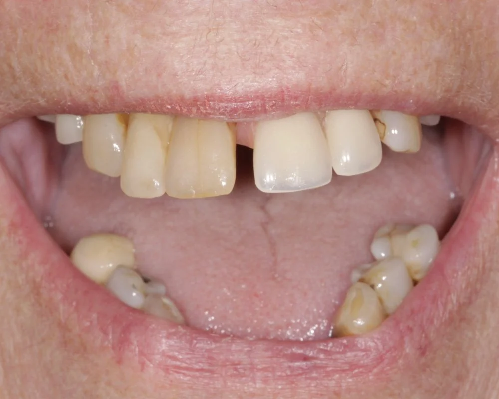 Dental Smiles Implant-Retained Dentures