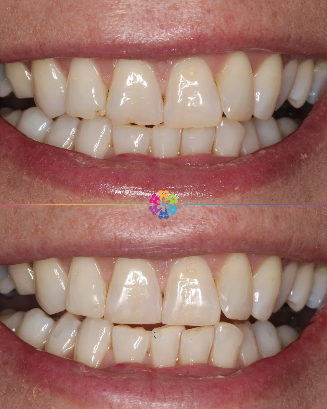 Composite bonding ✨

Over time enamel can wear down due to eating, clenching or grinding the teeth.

Composite edge bonding is not only great for improving the aesthetics of the teeth, but it also prevents the remaining enamel being worn away!

#dent