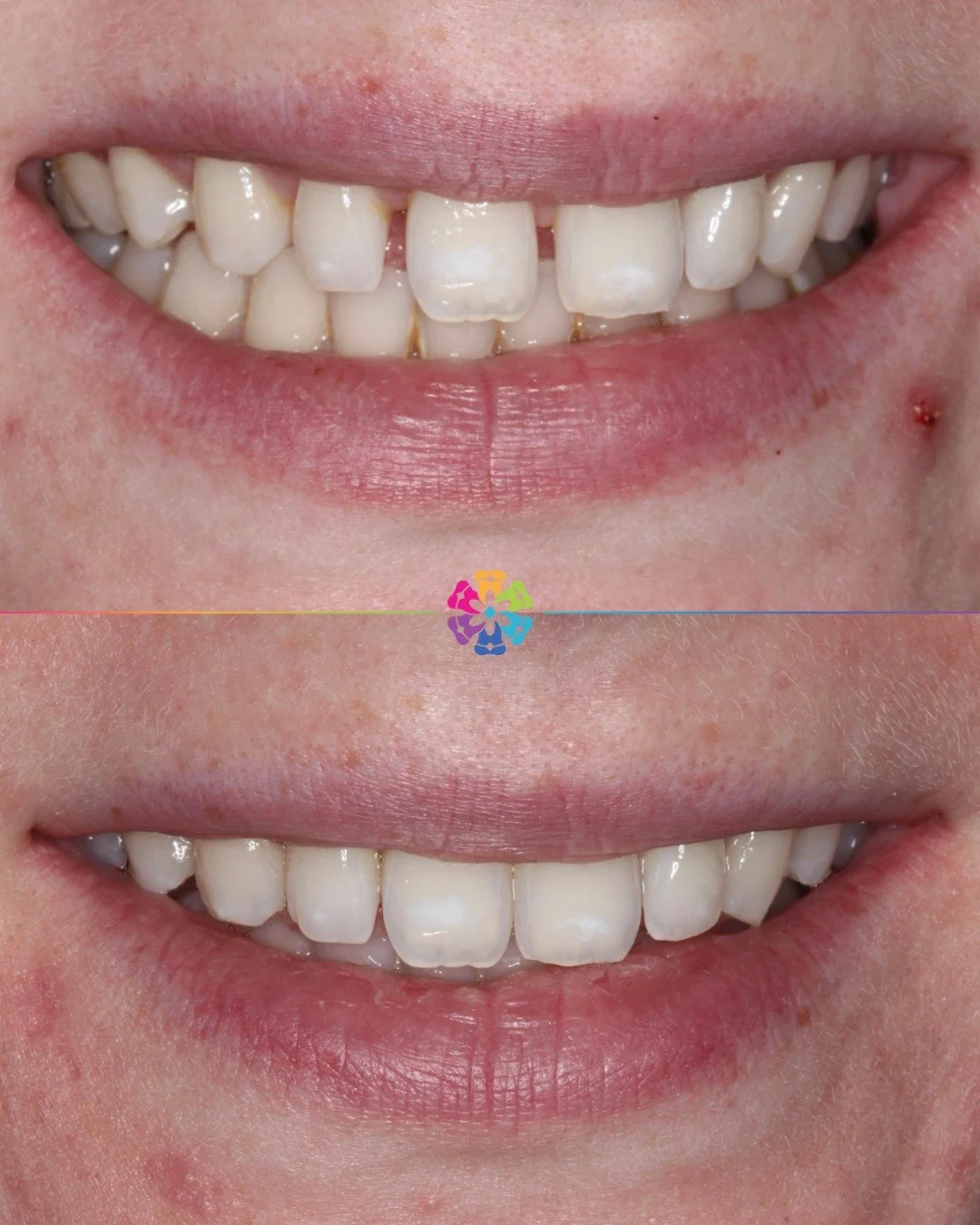 ✨Invisalign✨

This beautiful before &amp; after was achieved with Invisalign, gently closing spaces around the front teeth for a more confident, natural smile.
Subtle changes, big difference 💫

👩&zwj;⚕️ Dr Marianne Allen
📍Dental Smiles Chelmsford
