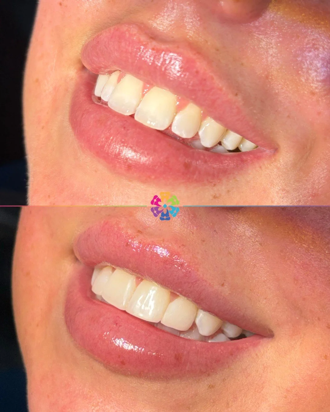 Composite Bonding Transformation 🦷✨

After Invisalign treatment, this patient wanted composite bonding to level out the teeth

Stunning results by Dr Nermine ✨

#dentalsmiles #compositebonding #beforeandafter #dreamsmile