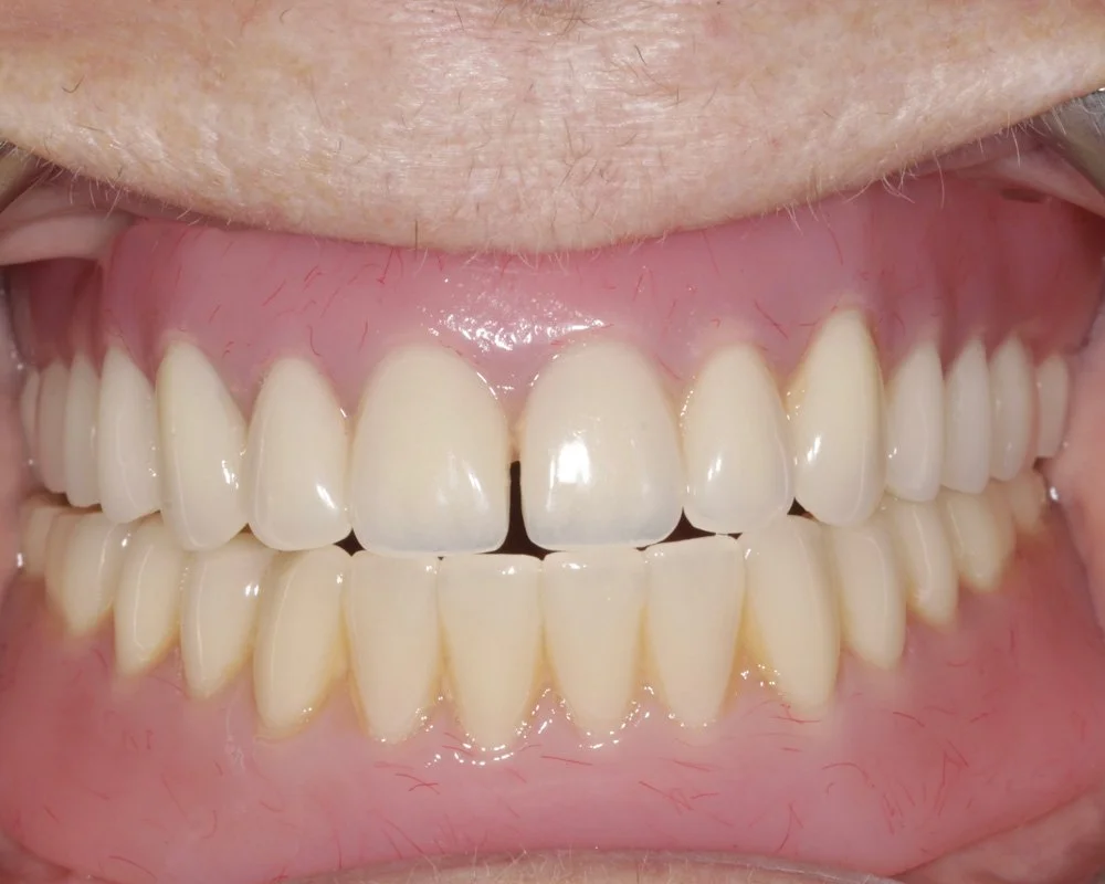 Final result of implant-retained denture placement