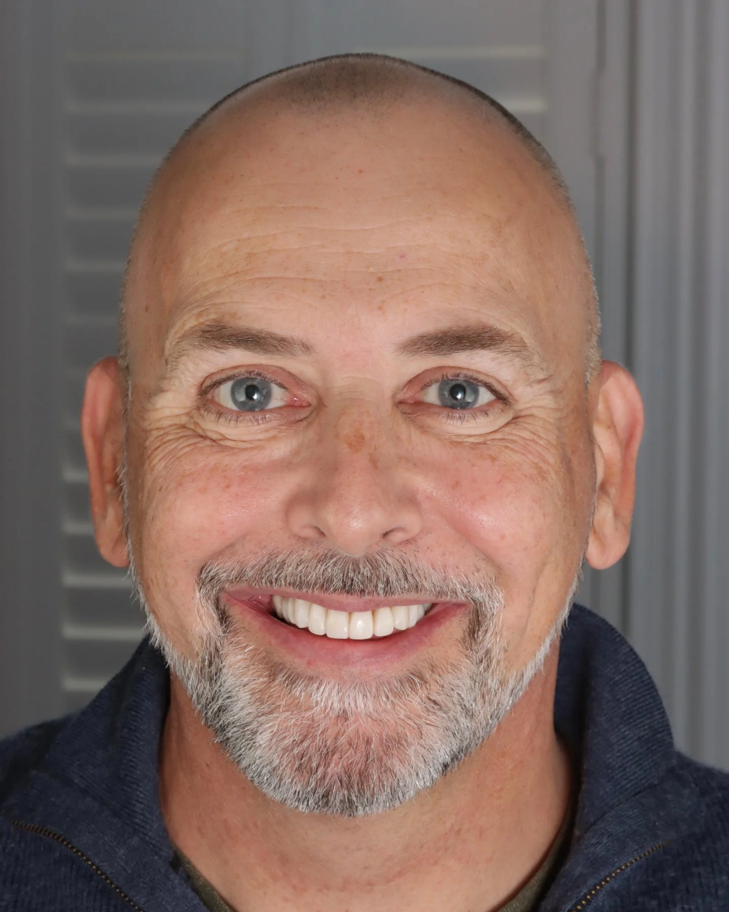 Whitening &amp; Composite Veneers ✨🦷

Dr Katy Sharpe transforming smiles

#dentalsmilesessex #dentalsmiles #whitening #composite