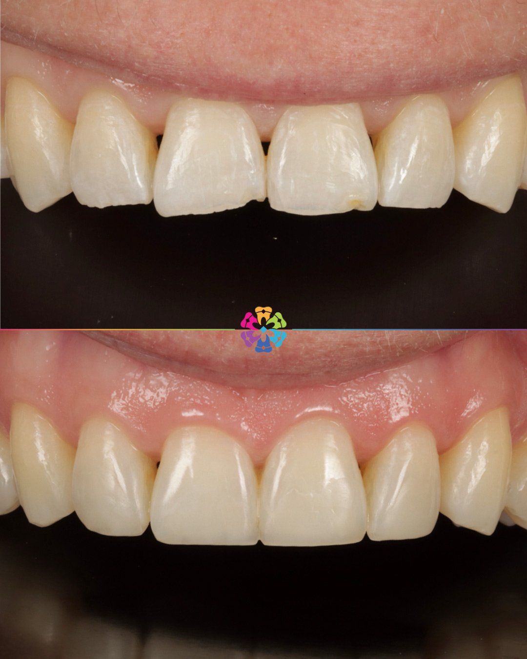 Composite Bonding