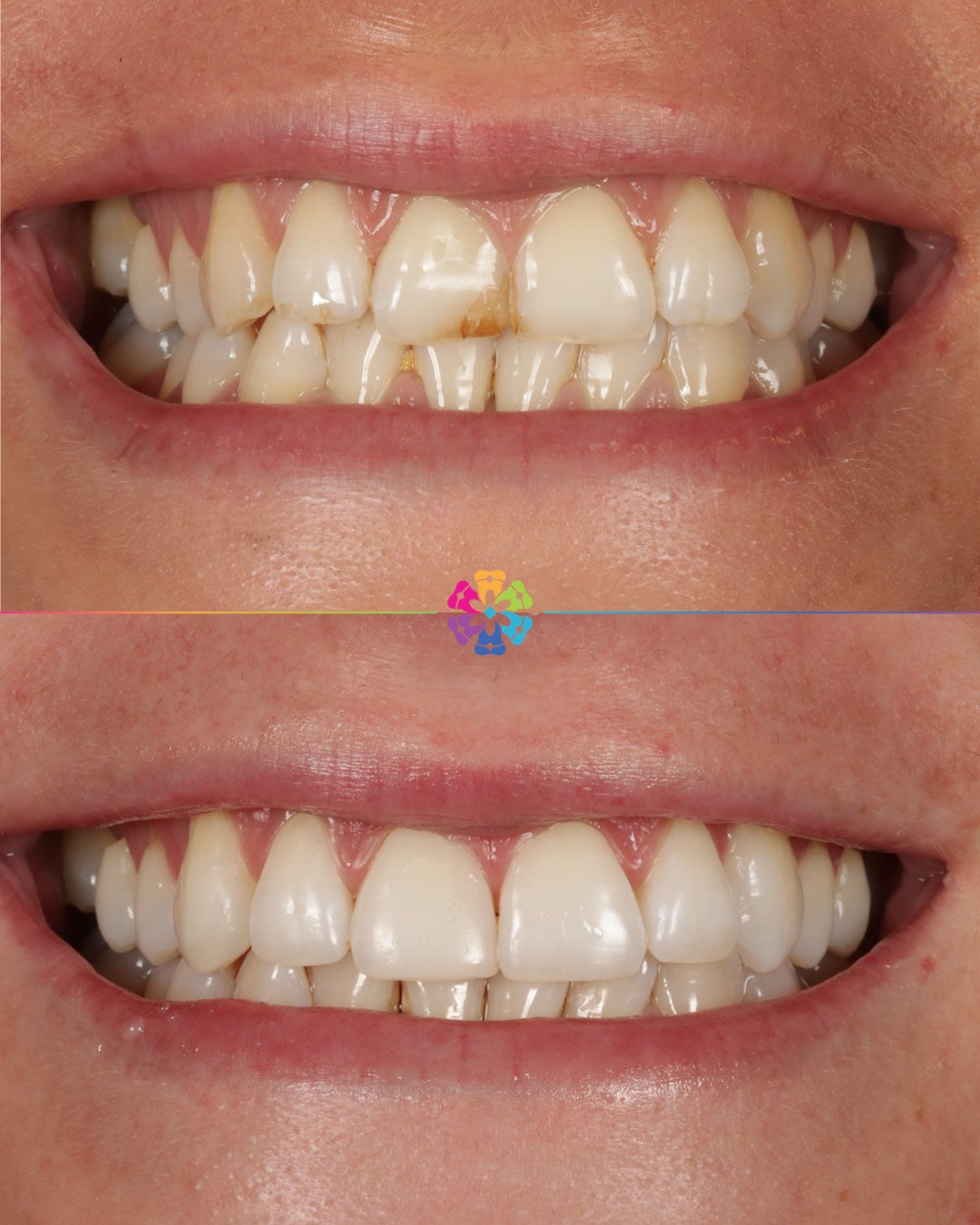 Invisalign, Whitening and Bonding