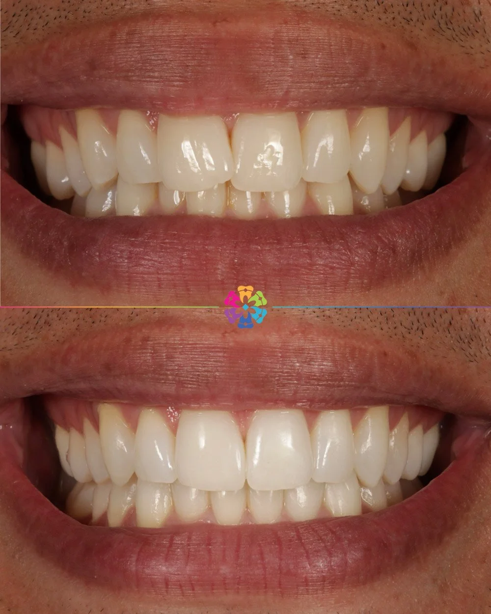 Invisalign, Whitening and Bonding