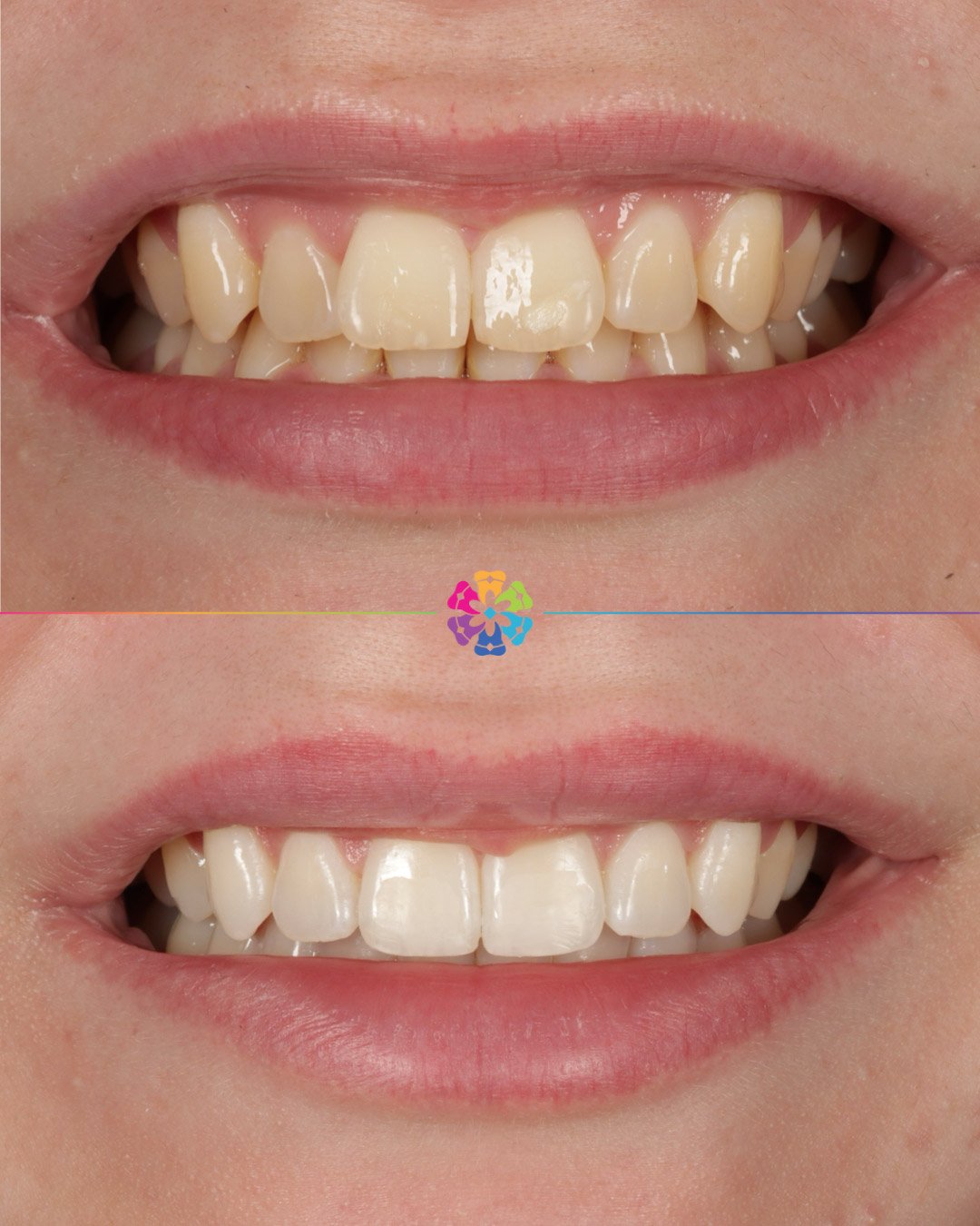 Invisalign, Whitening and Bonding