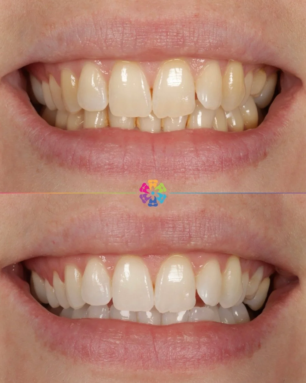 Whitening