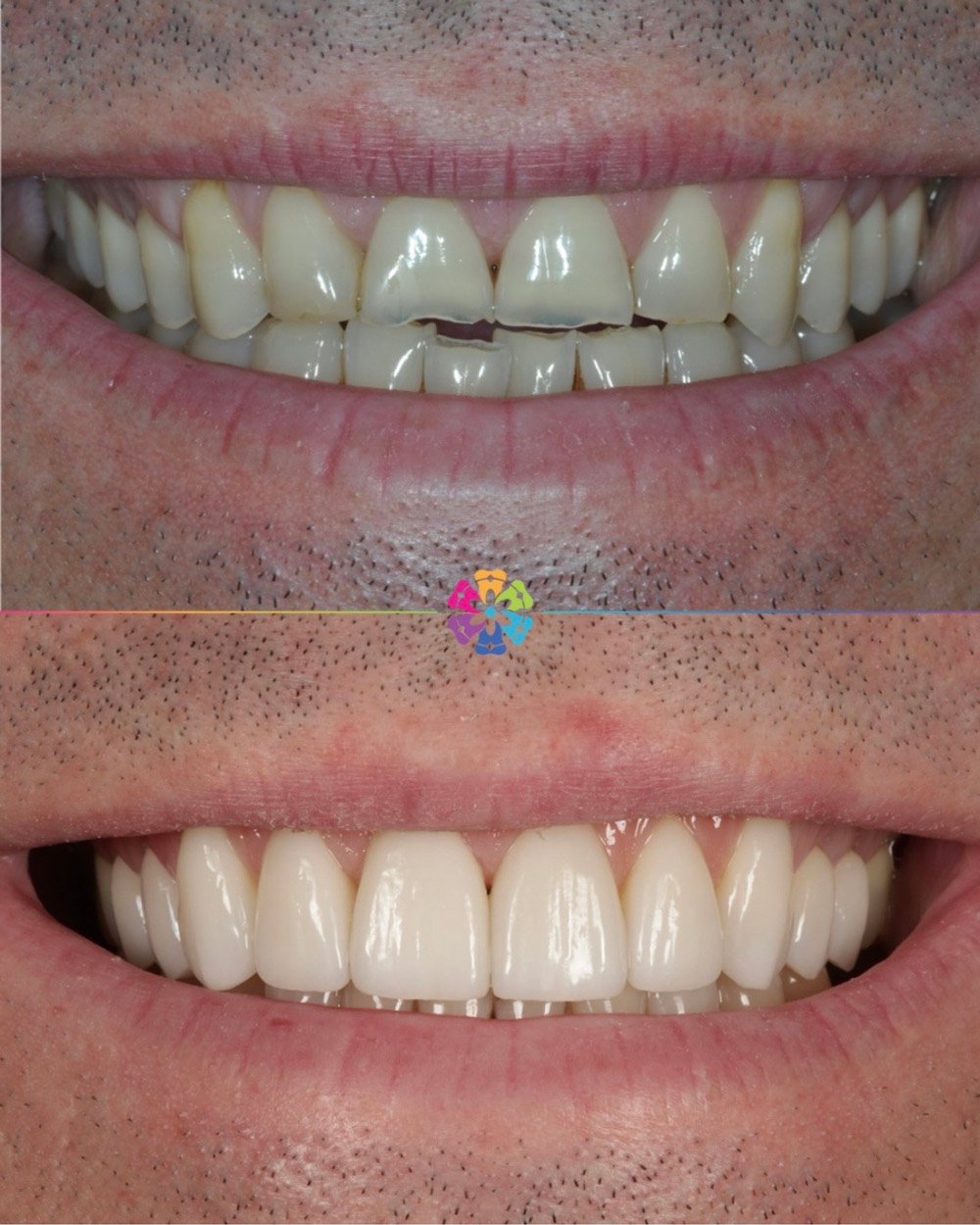 Smile Makeover