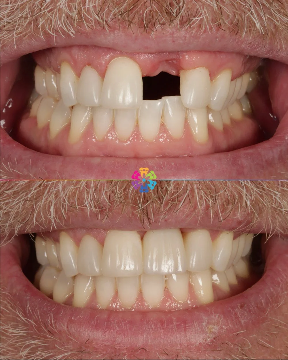 Smile Makeover