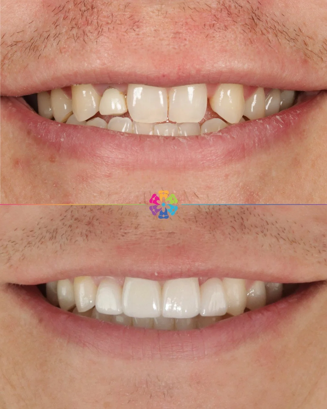 Smile Makeover