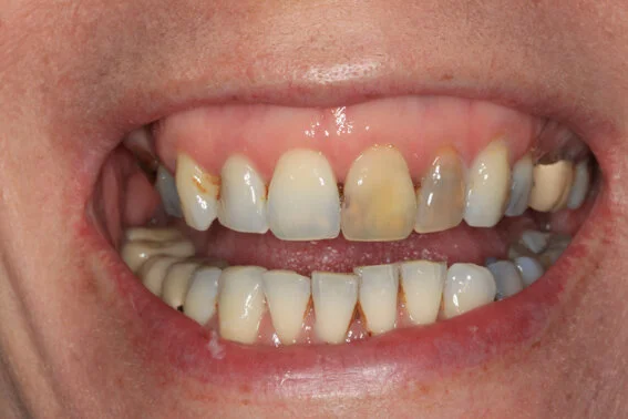 Pre-treatment Veneers and whitening