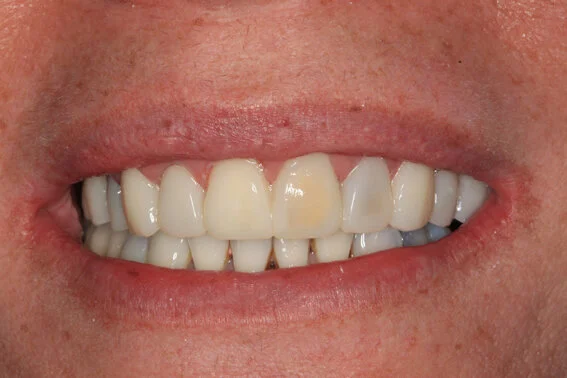 Temporary Veneers