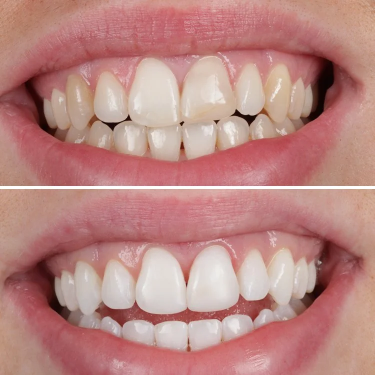 Composite bonding in Colchester