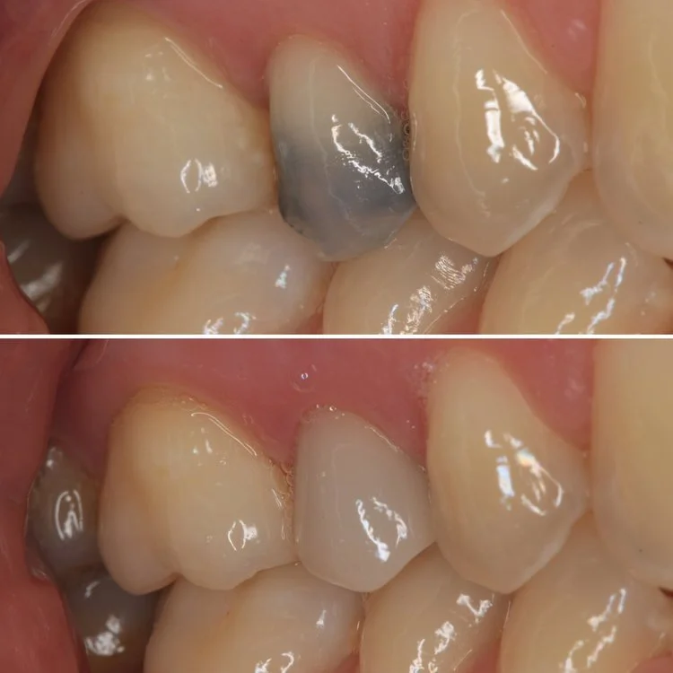 Porcelain Onlays and Crowns in Colchester