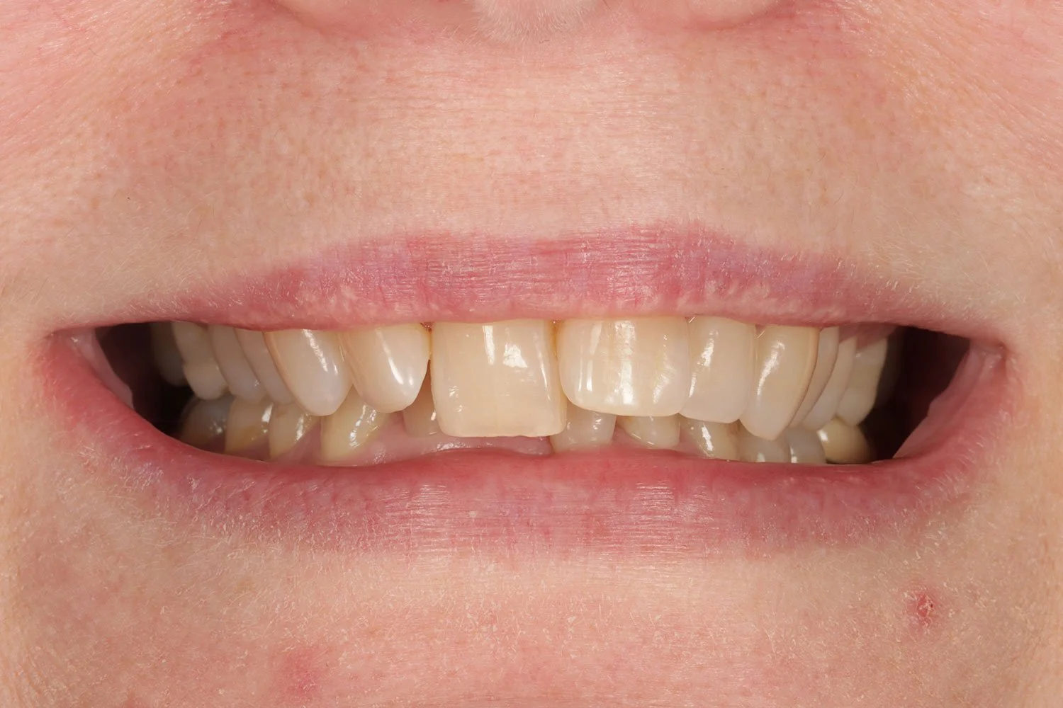 Before Invisalign treatment by Dr Katy Sharpe