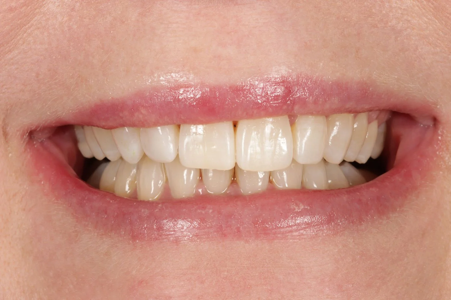After Invisalign treatment by Dr Katy Sharpe
