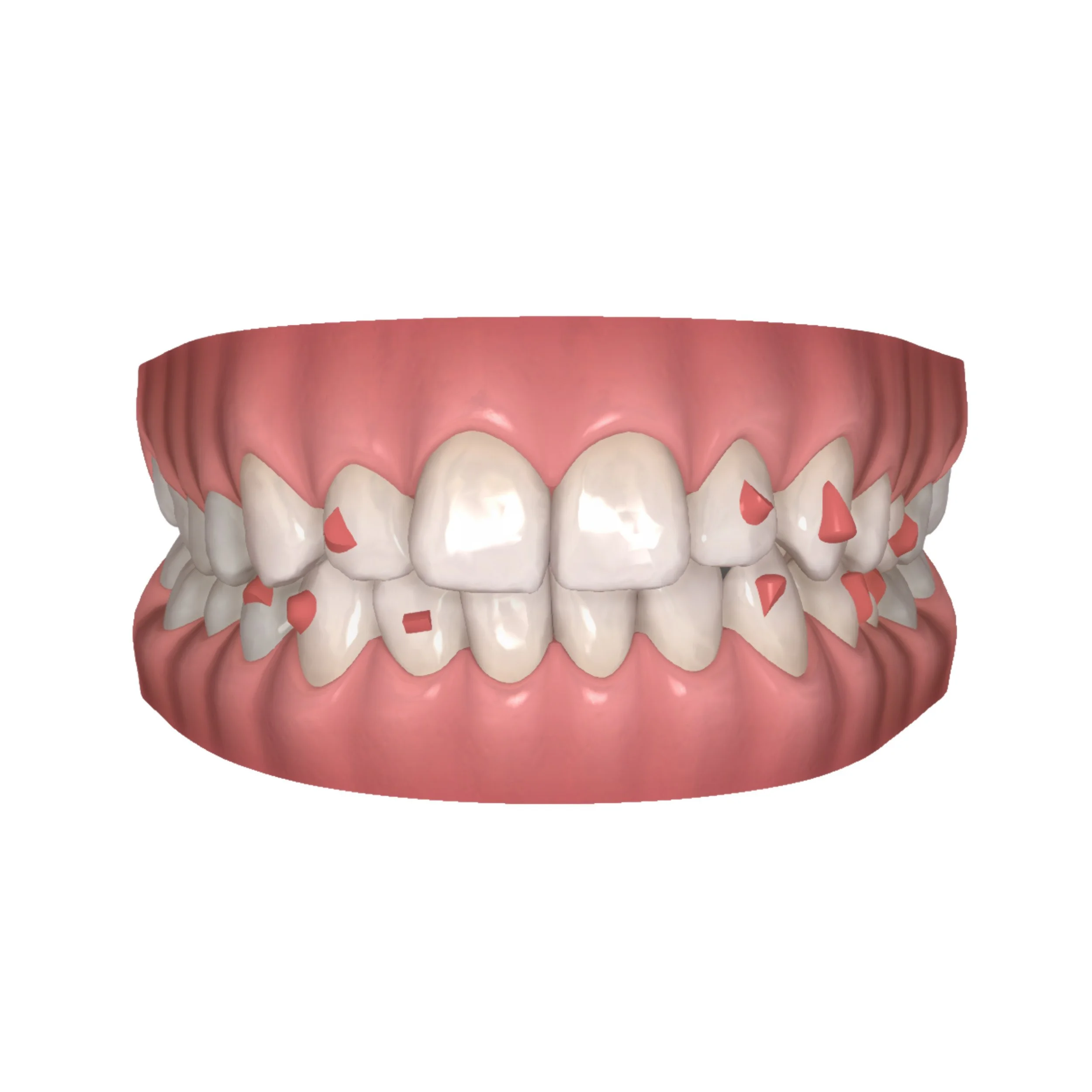 What are Invisalign attachments?