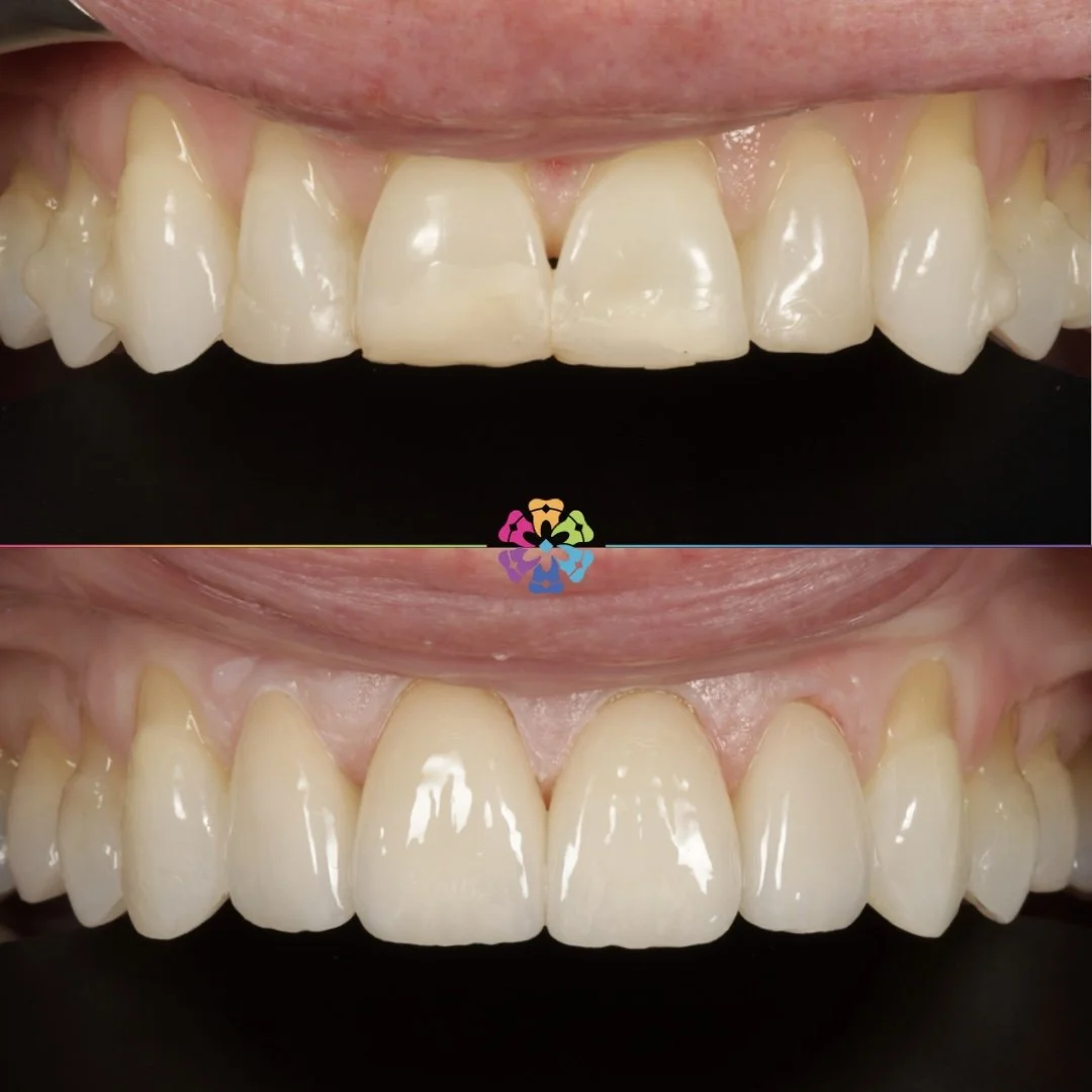 Porcelain Onlays and Crowns at Dental Smiles