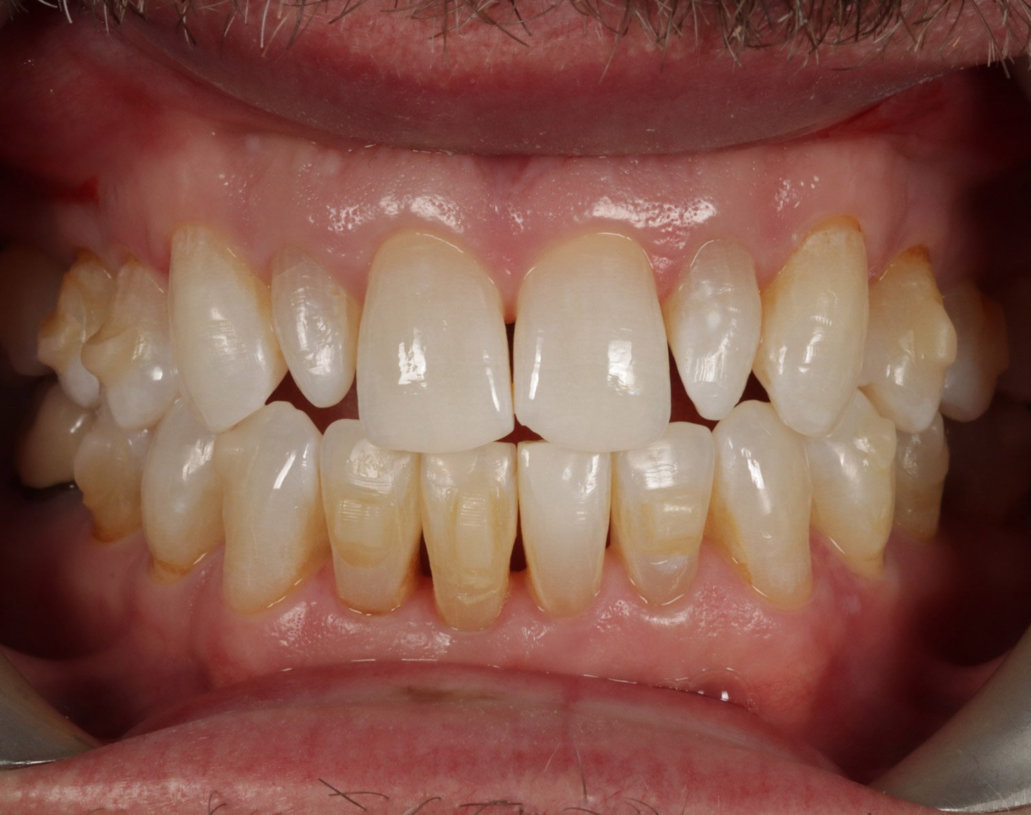 Dental Smiles Blog - Invisalign attachments