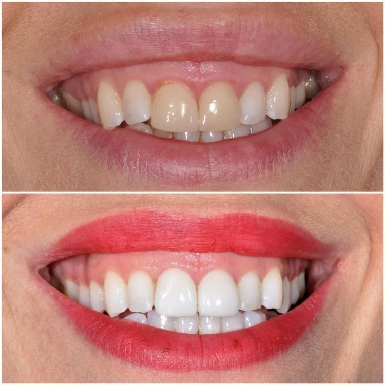 Before and After Invisalign Braces