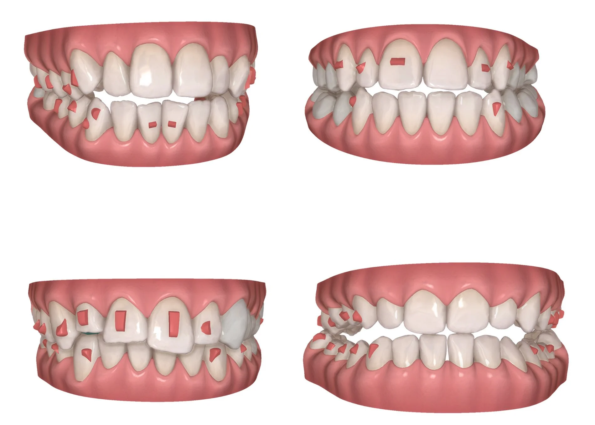 What are Invisalign attachments? Dental Smiles explains...