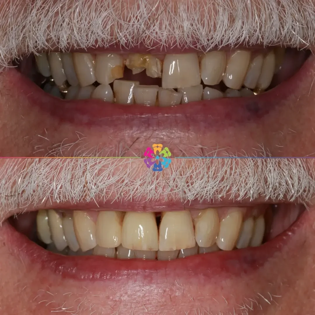 Dental Implants before and after treatment at Dental Smiles Chelmsford