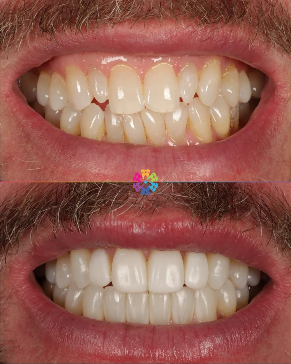 Teeth straightening with Invisalign before and after