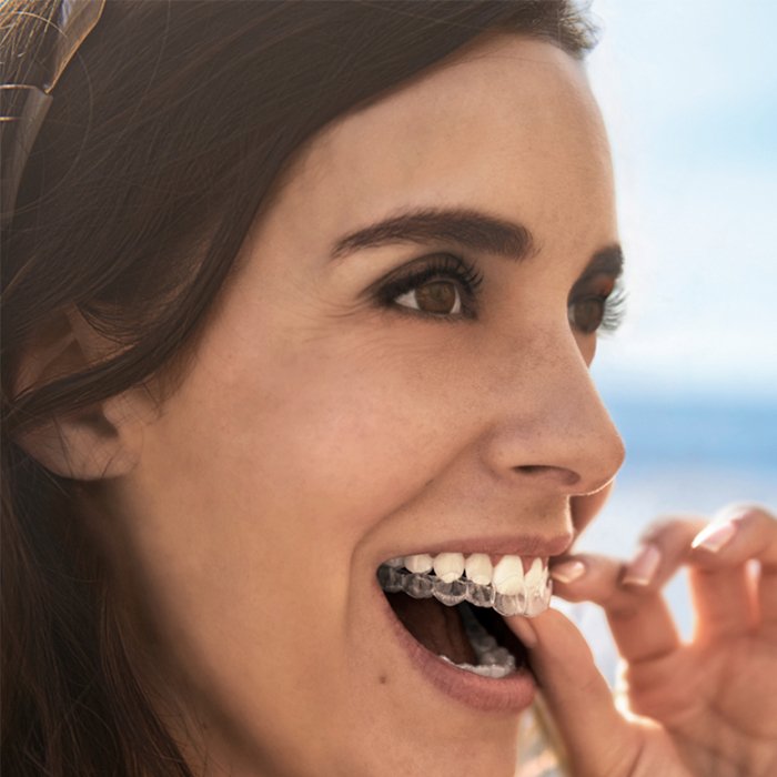 Invisalign® Completion
