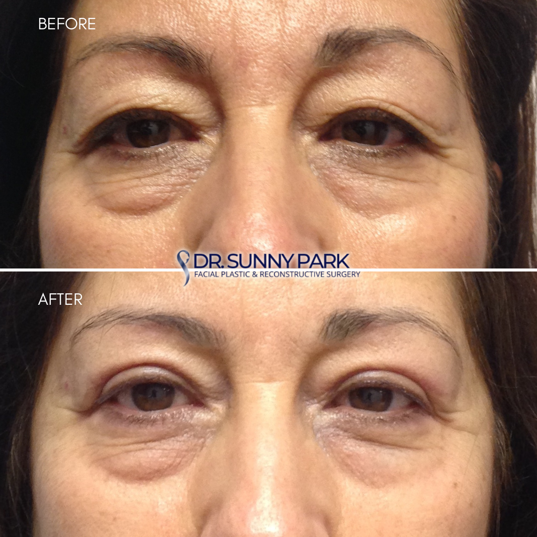 Upper blepharoplasty