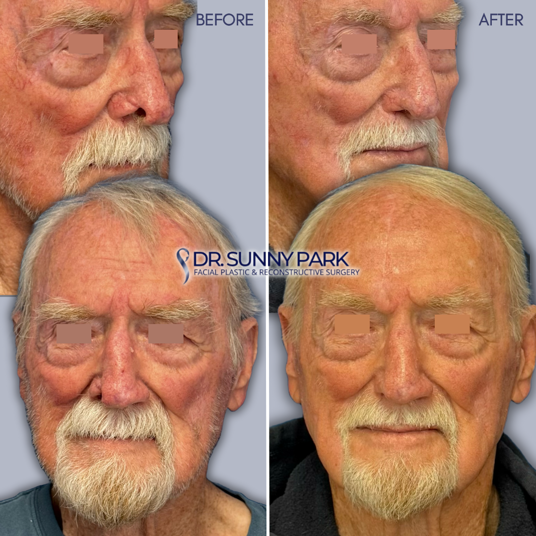 Results of forehead flap to reconstruct nose following a through-and-through defect 
