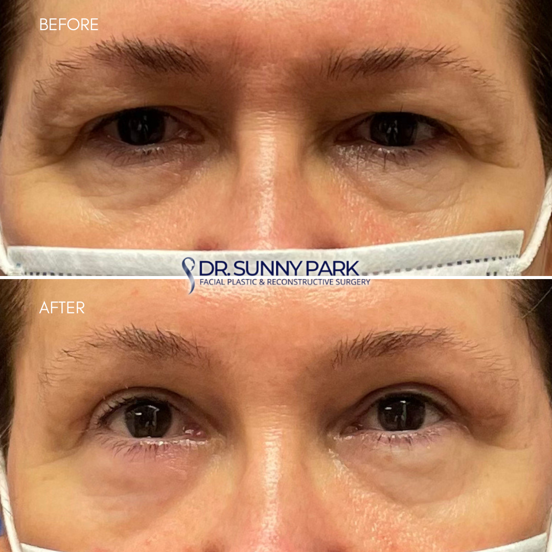 Upper blepharoplasty