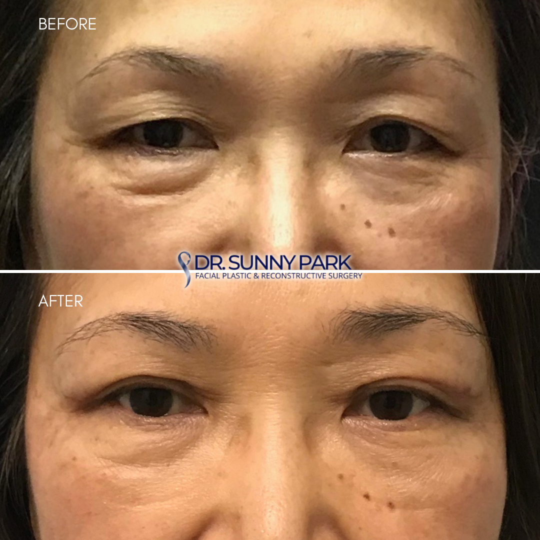 Asian Blepharoplasty: Patient had excess upper eyelid skin. Dr. Park performed an upper blepharoplasty. The picture after surgery shows rejuvenated upper eyelids.
