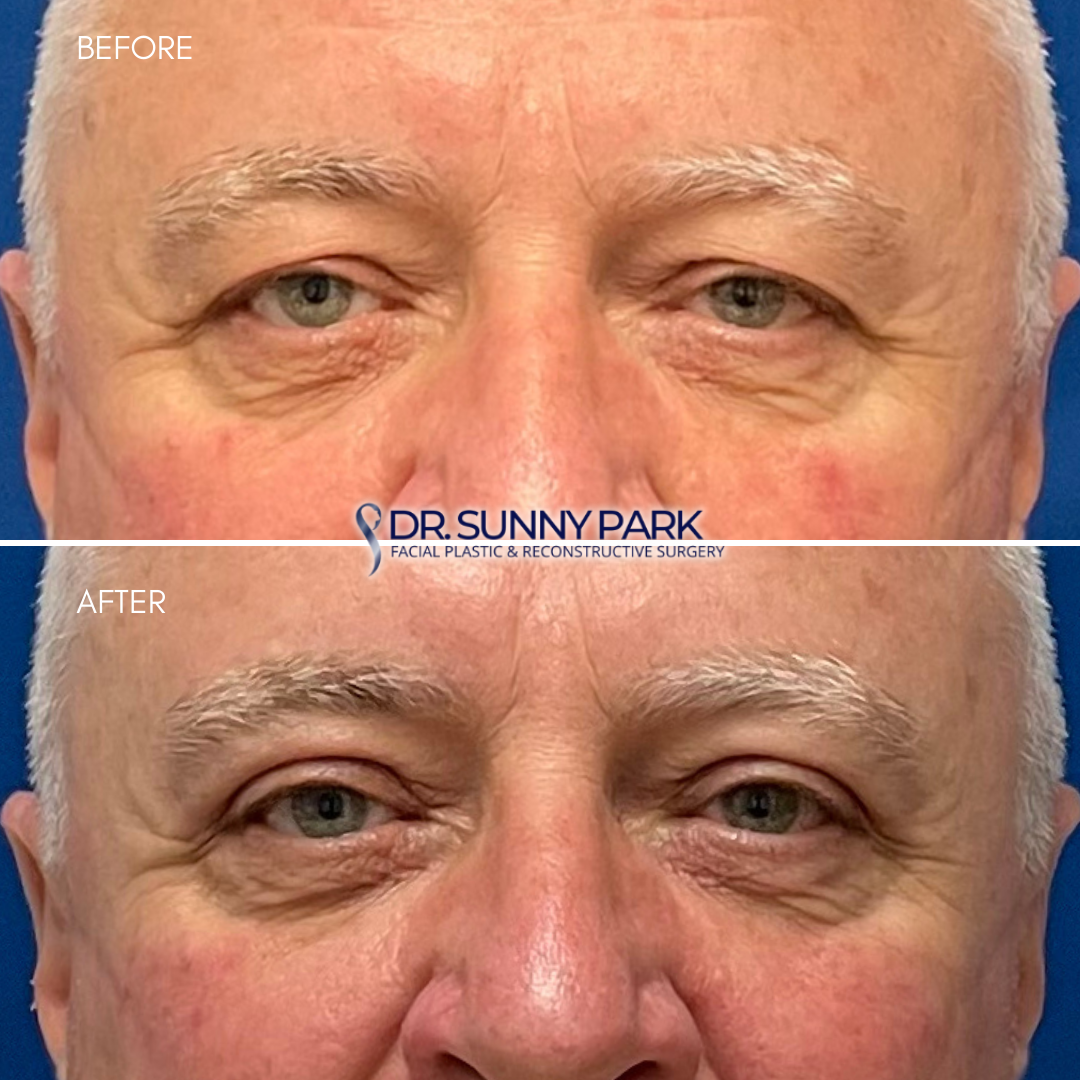 Upper blepharoplasty