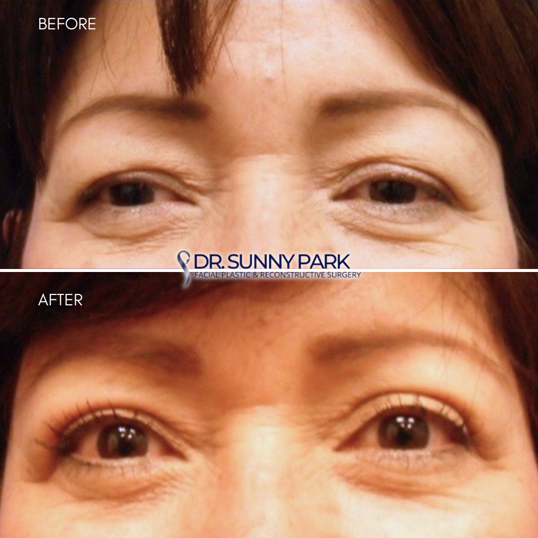 A patient with excess upper eyelid skin creating a tired-look. After an upper eyelid surgery.